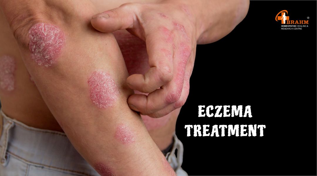 eczema